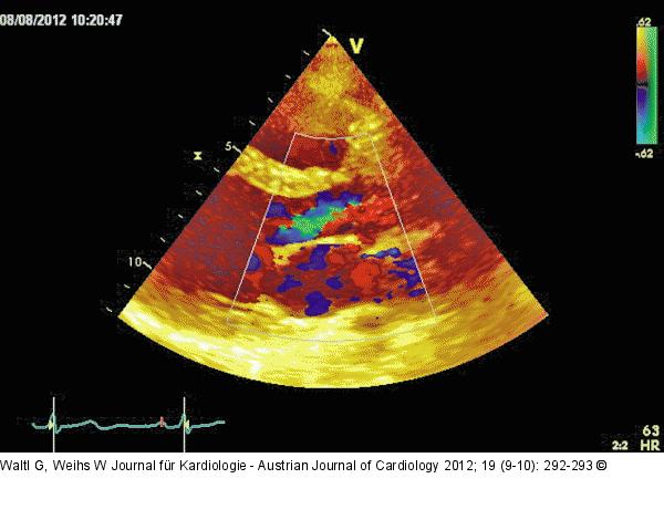 Parasternaler Längsschnitt