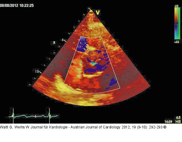 Parasternaler Querschnitt