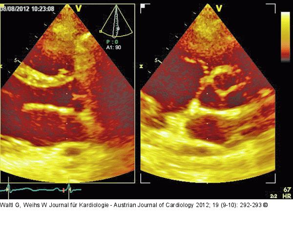 Parasternaler Längsschnitt - Parasternaler Querschnitt