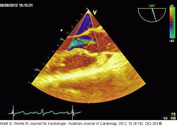 Transösophageales Echo