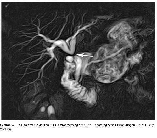 Cholecystektomie - Choledochusrevision