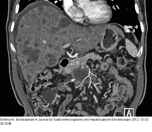 Pankreas - Adenokarzinom
