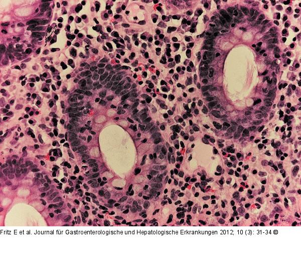 Lymphozytäre Kolitis