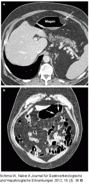 Magen - Polypoide Raumforderung