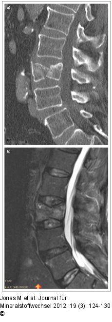 Sagittaler Spaltbruch