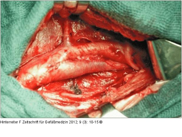 Eversionsendarteriektomie