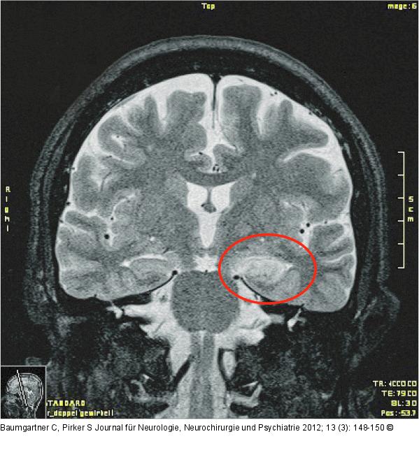 Limbische Enzephalitis