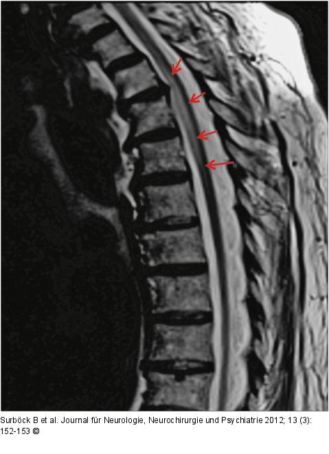 Arteria-spinalis-anterior-Syndrom
