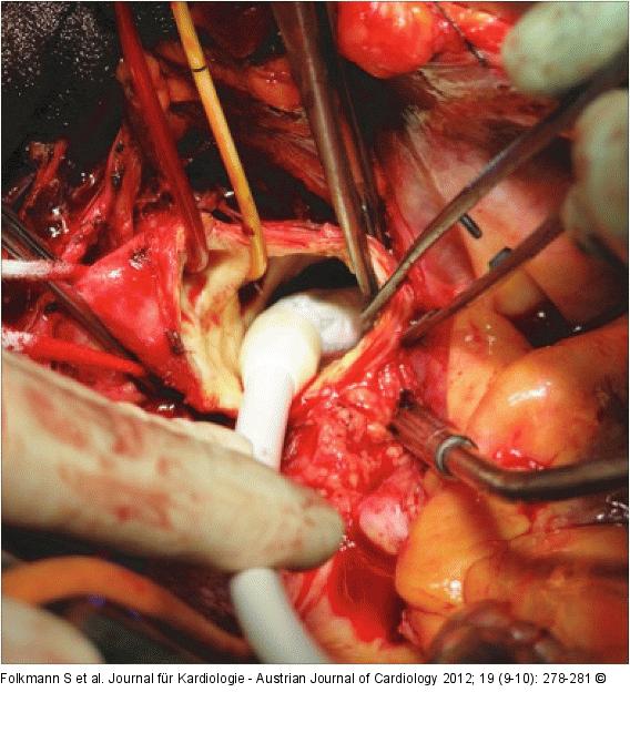 Frozen-elephant-trunk