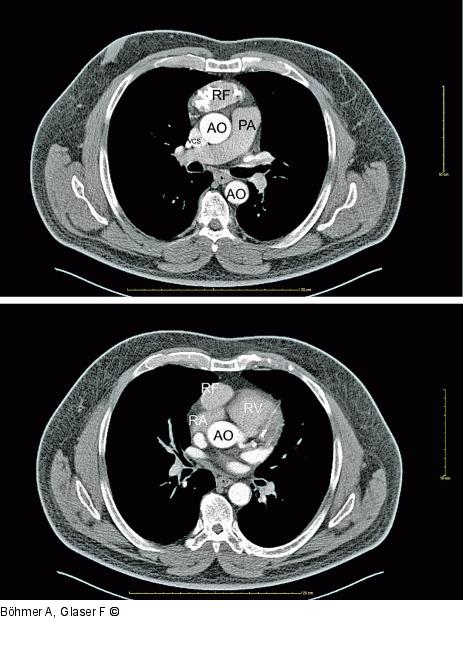 CT mit Kontrastmittel