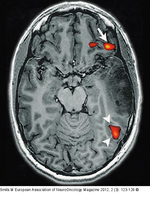 Brain tumour