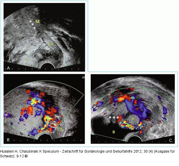 Placenta praevia percreta