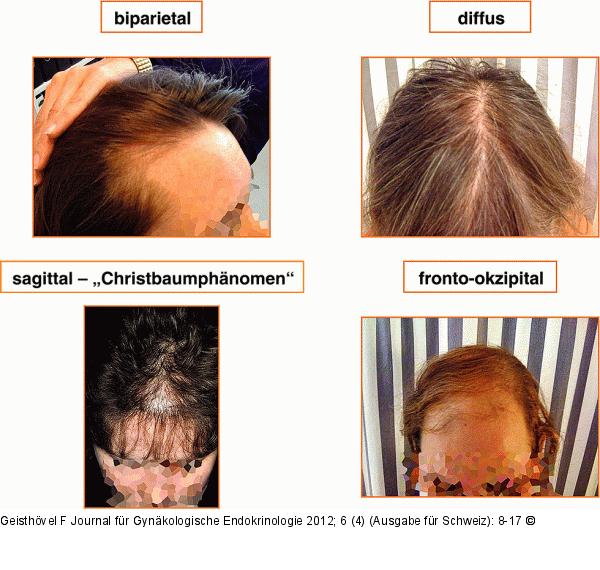 Alopecia androgenetica