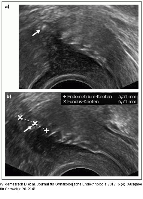 Gynefix(R) - Verankerung