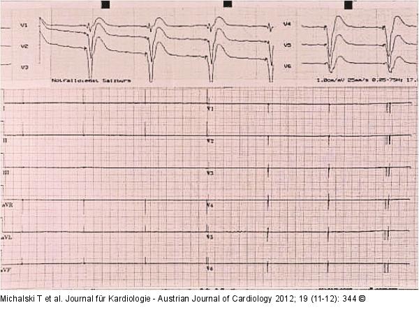 Letales EKG
