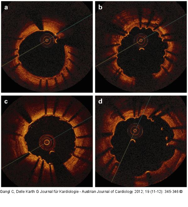 Stent-Struts