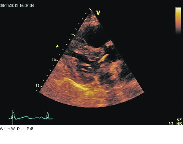 Parasternaler Längsschnitt