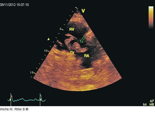 Rechtsventrikulärer Einflusstrakt