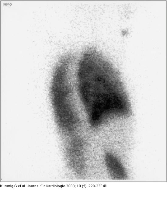 Lungenperfusionsszintigraphie