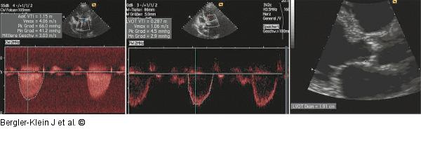 Aortenklappenöffnung