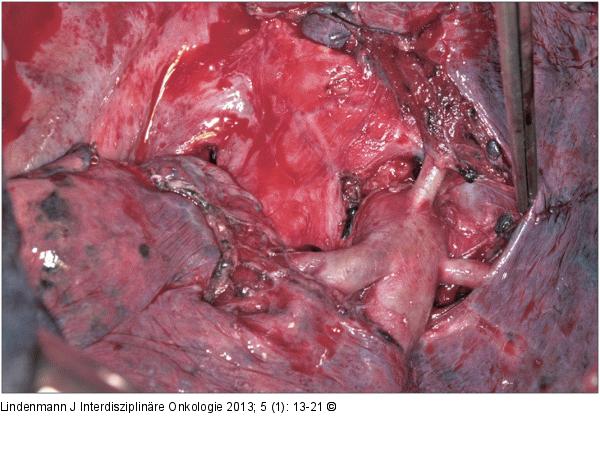 Lymphadenektomie 