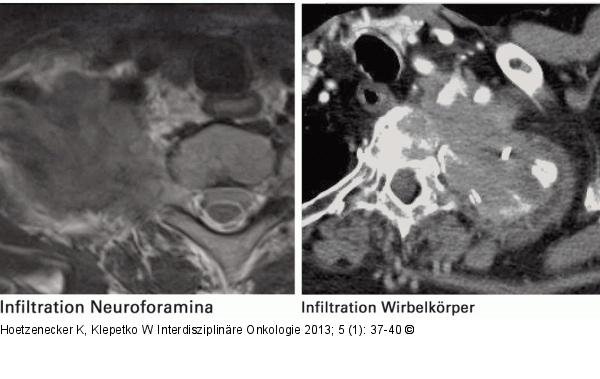 Infiltration - Wirbelsäule