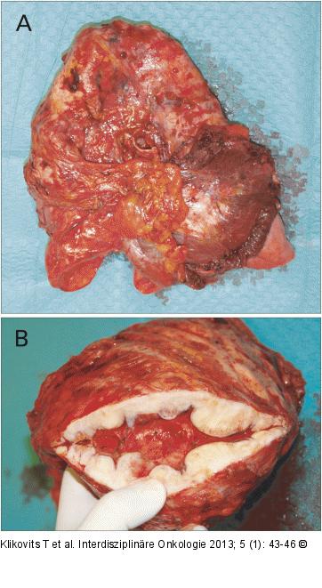 Pneumonektomiepräparat 