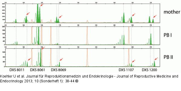 Polar body diagnosis for haemophilia A