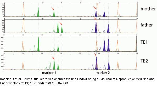 PGD for Spinal Muscular Atrophy, SMA