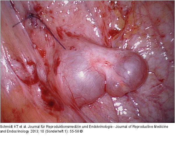 Spontaneous follicular development
