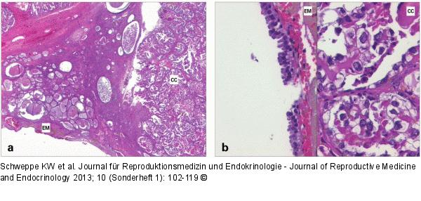 Adenocarcinoma