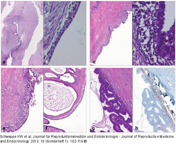 Ovarian endometriosis