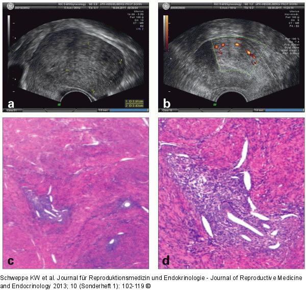 Adenomyosis uteri interna