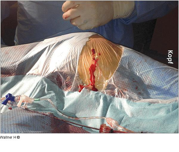 Punktion - Arteria femoralis superficialis