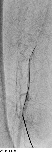 Punktion - Arteria femoralis superficialis