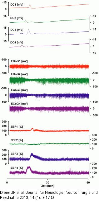 Spreading Depolarization