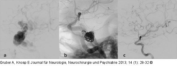 Karotis-Sinus-cavernosus-Fistel