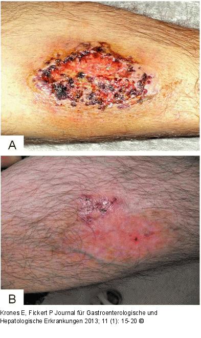 Pyoderma gangraenosum