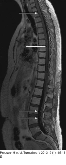 Meningeosis carcinomatosa