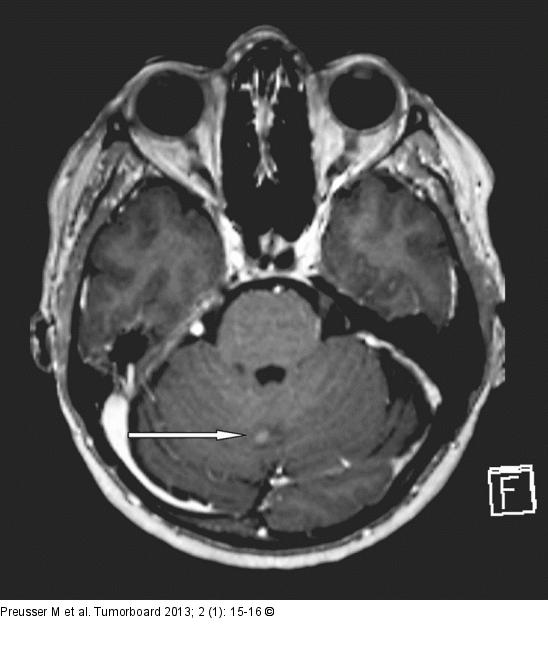 Meningeosis carcinomatosa