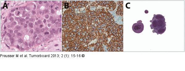 Meningeosis carcinomatosa