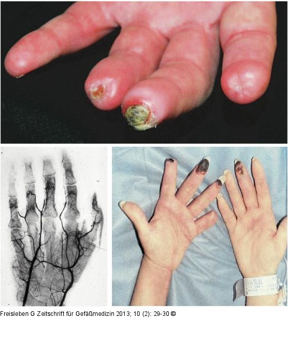 Systemische Sklerose