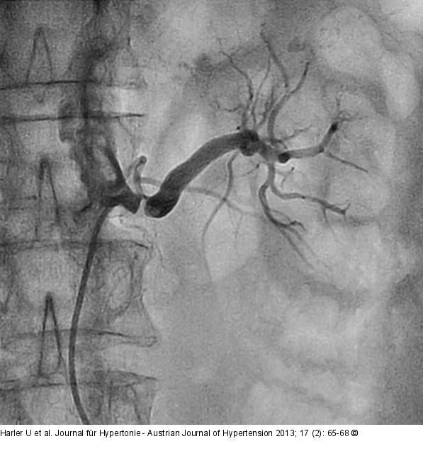Nierenarterienstenose