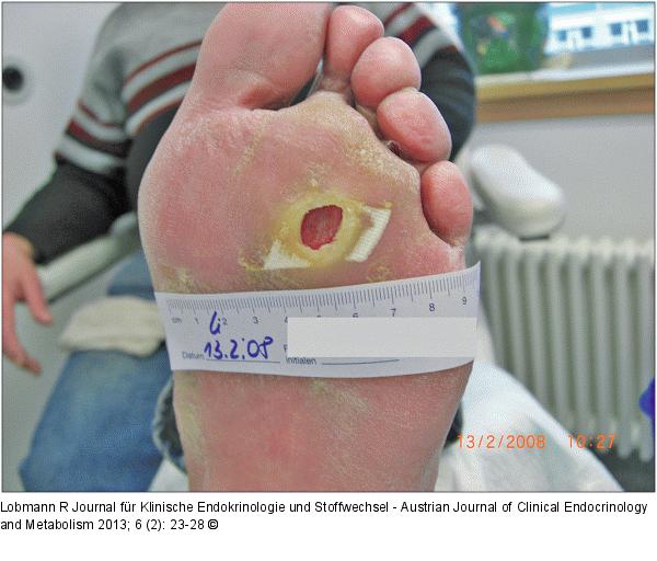 Diabetisches Fußsyndrom