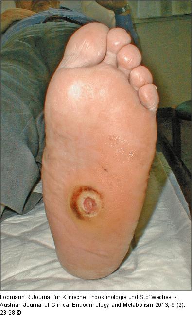 Diabetisches Fußsyndrom