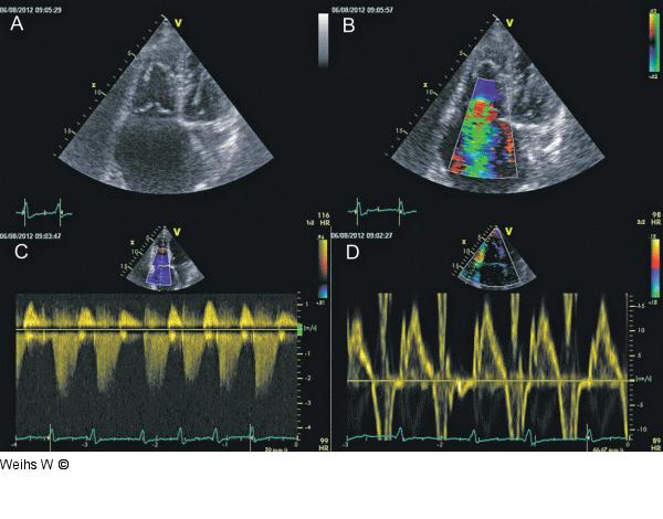 Trikuspidalinsuffizienz