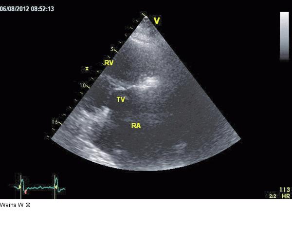 Rechtsventrikulärer Einflusstrakt