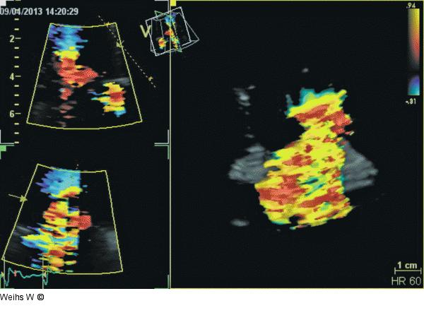Trikuspidalinsuffizienz