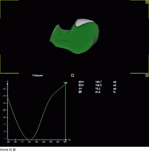 Volumen - Auswurffraktion