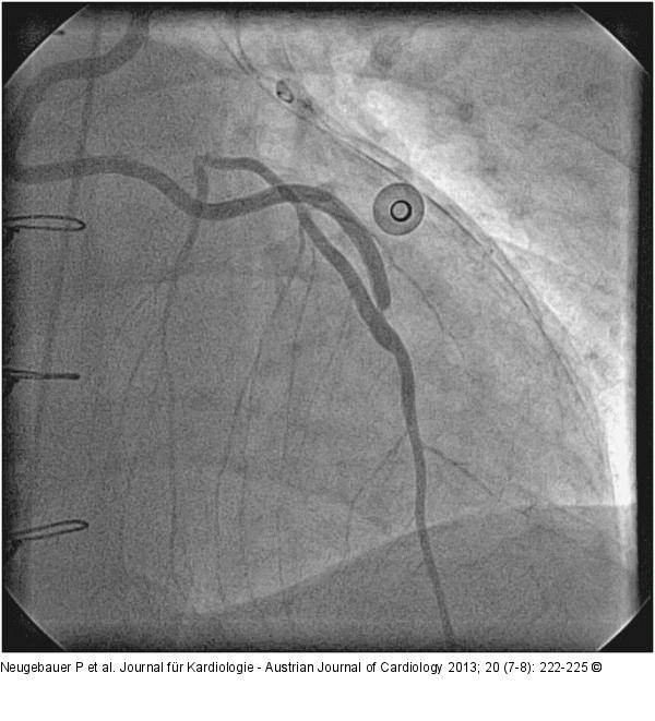 Catheter-Induced Dissection